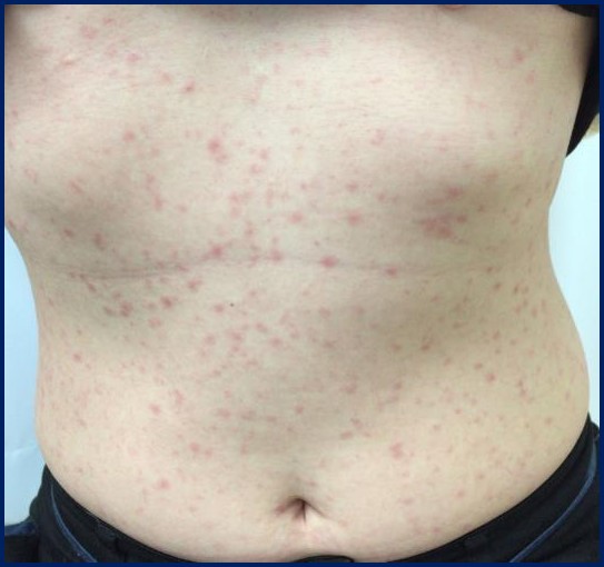 腹部の症状写真